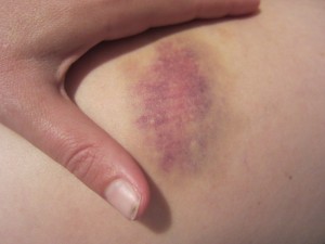 Hand-sized Bruise